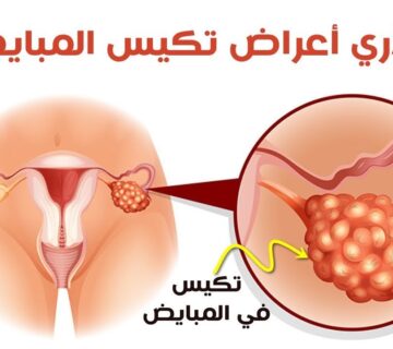اعراض تكيس المبايض