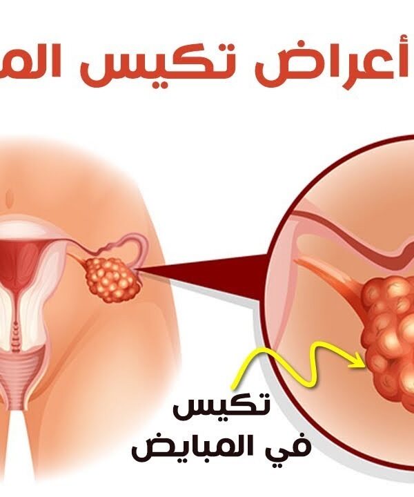 اعراض تكيس المبايض