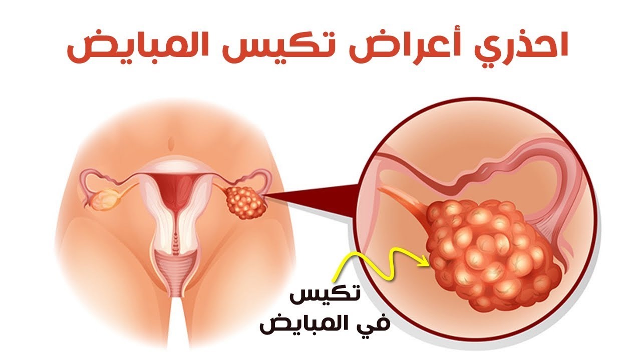 اعراض تكيس المبايض