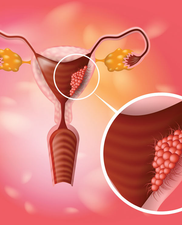 أسباب العقم عند النساء