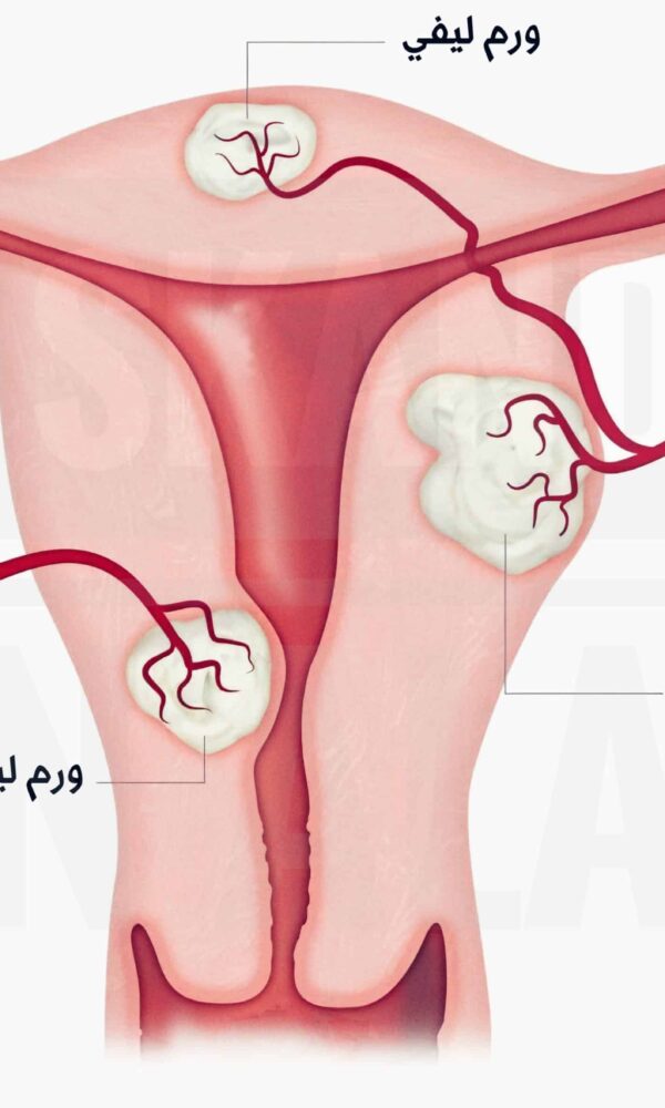 أعراض الأورام الليفية في الرحم