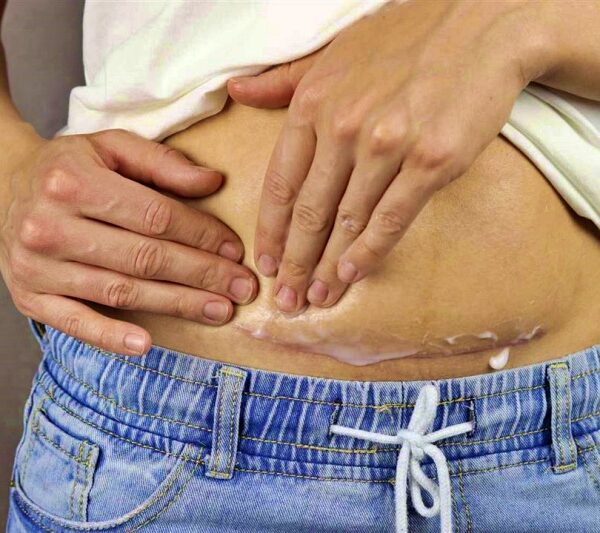 أعراض التهاب الرحم بعد الولادة القيصرية