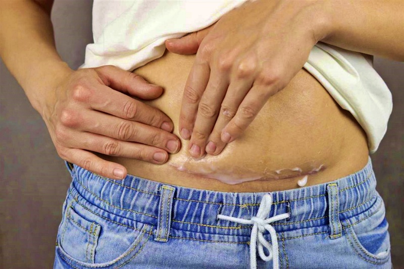 أعراض التهاب الرحم بعد الولادة القيصرية