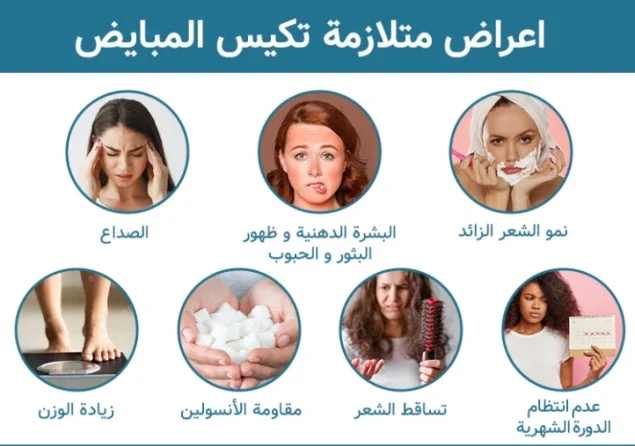 أعراض تكيس المبايض الخفيف