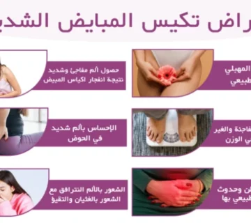 أعراض تكيس المبايض الشديد