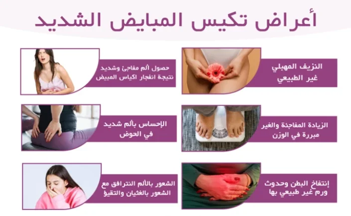 أعراض تكيس المبايض الشديد