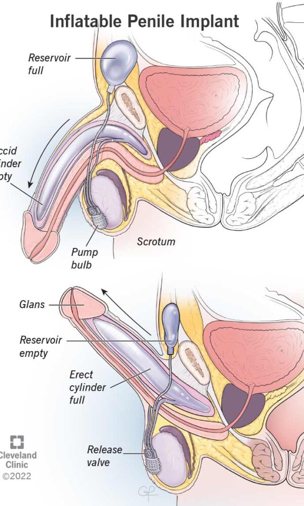 ألم بعد عملية الدعامة الذكرية