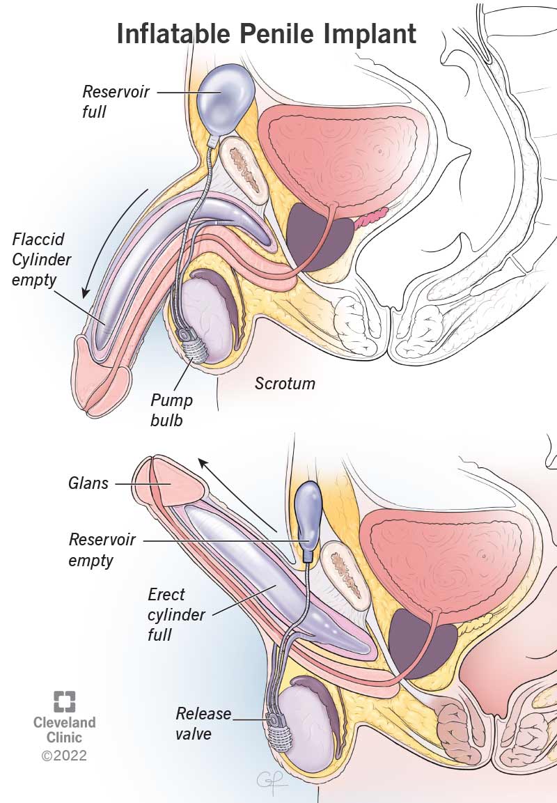 ألم بعد عملية الدعامة الذكرية
