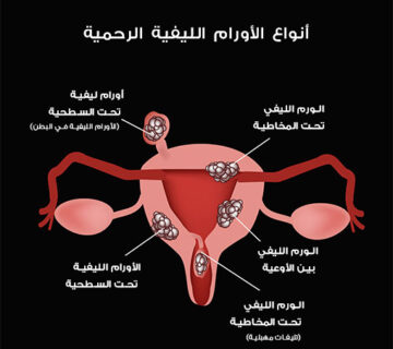 اسباب الاورام الليفية في الرحم