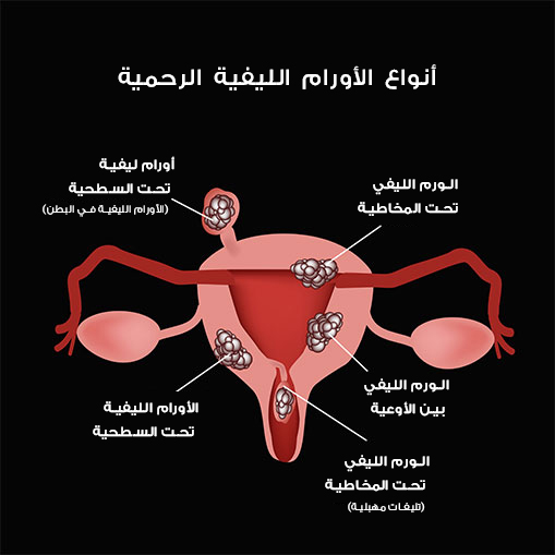 اسباب الاورام الليفية في الرحم