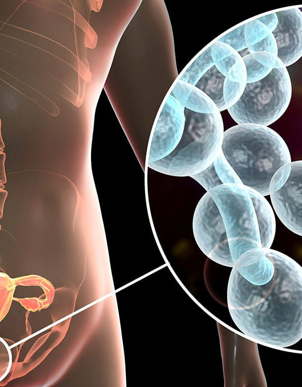 اسباب عدوى المهبل