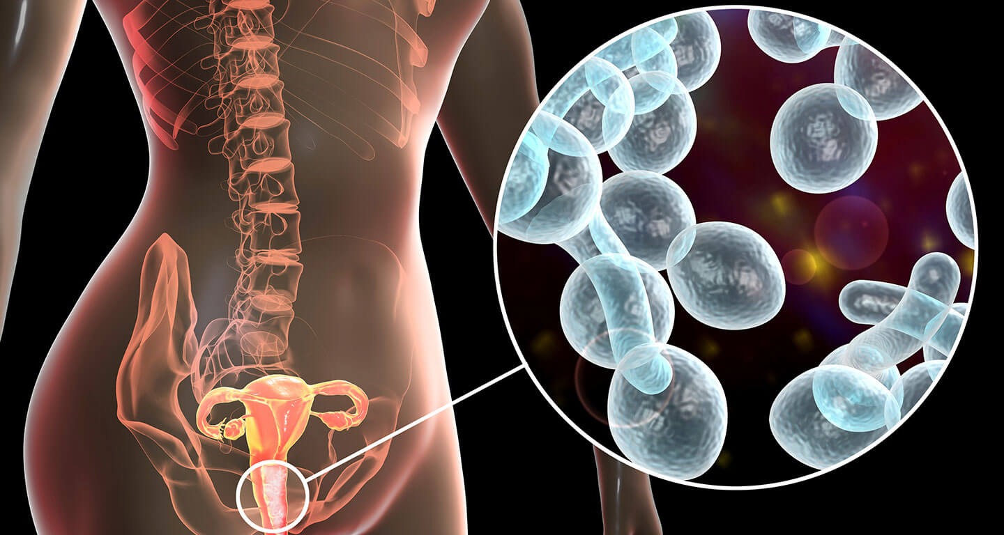 اسباب عدوى المهبل