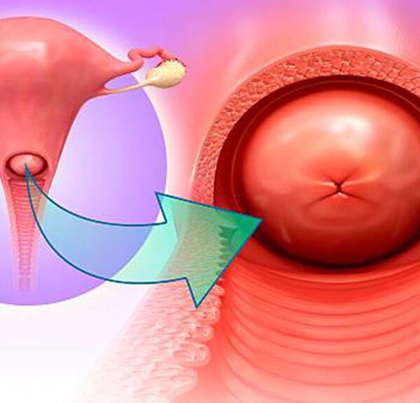 التهاب الرحم