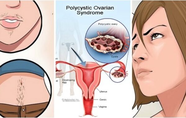 اعراض تكيس المبايض
