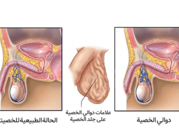 اعراض دوالي الخصية