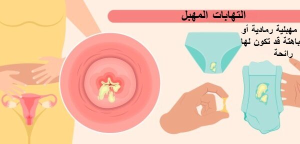 عدوي المهبل