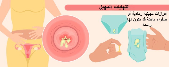 عدوي المهبل