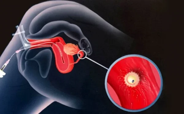 الحقن الصناعي لتحديد نوع الجنين