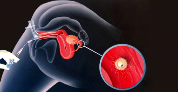 الحقن الصناعي لتحديد نوع الجنين