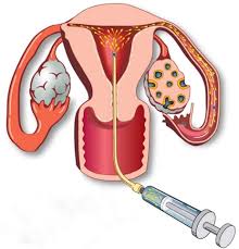 الحقن الصناعي للحمل