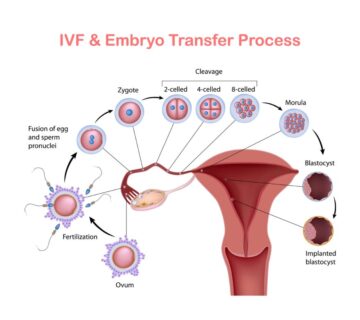 العقم عند النساء