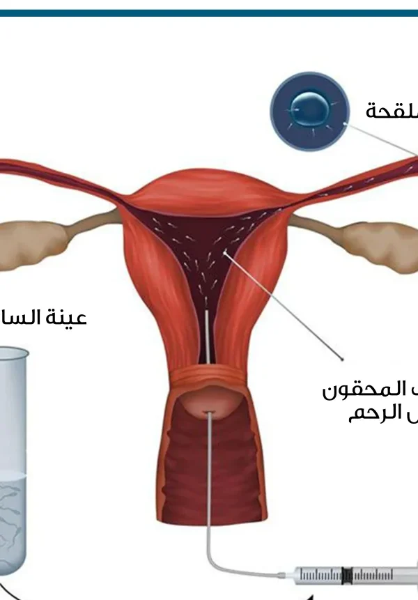 الوقاية من العقم عند النساء