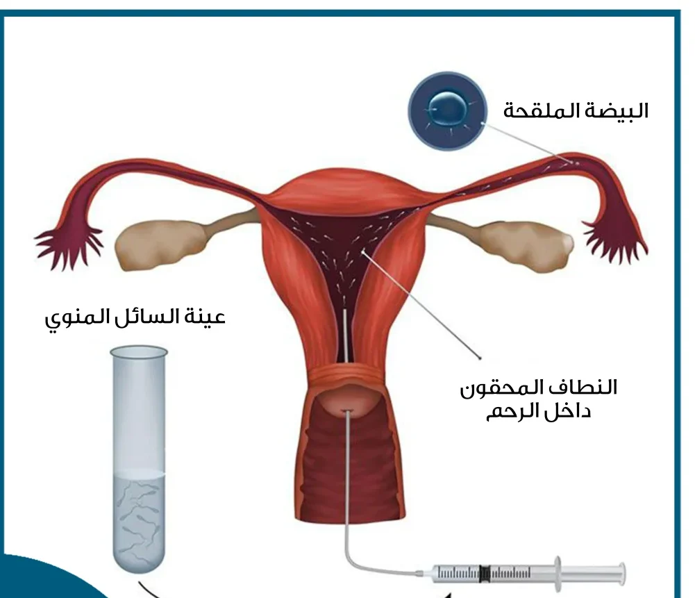 الوقاية من العقم عند النساء