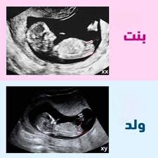 تحديد نوع الجنين في الشهر الكام
