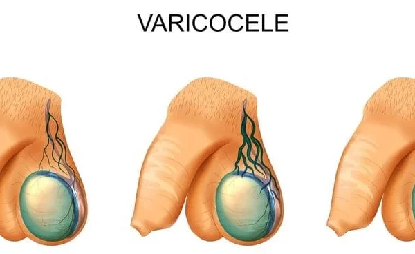 درجات دوالي الخصية بالصور
