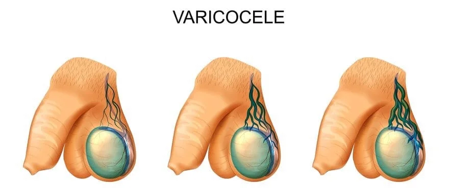 درجات دوالي الخصية بالصور