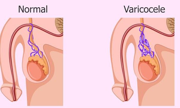 دوالي الخصية