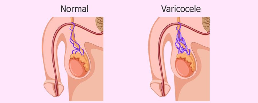 دوالي الخصية