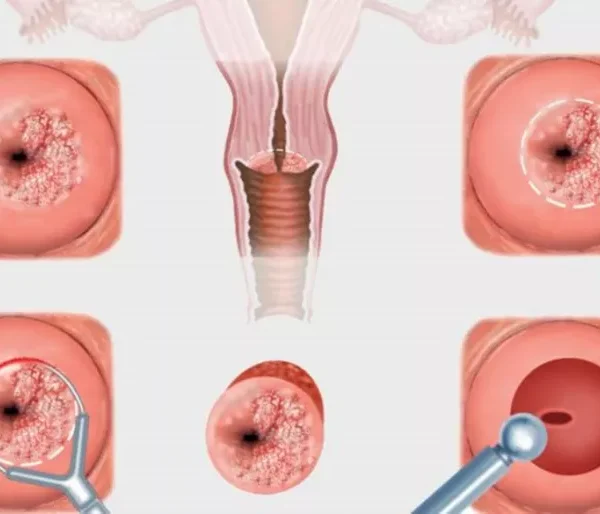 سبب التهاب الرحم