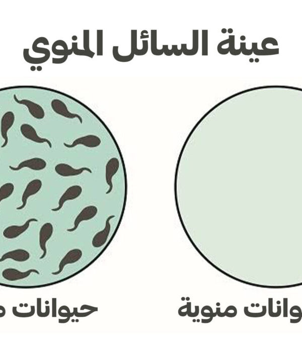 سبب ضعف الحيوانات المنويه