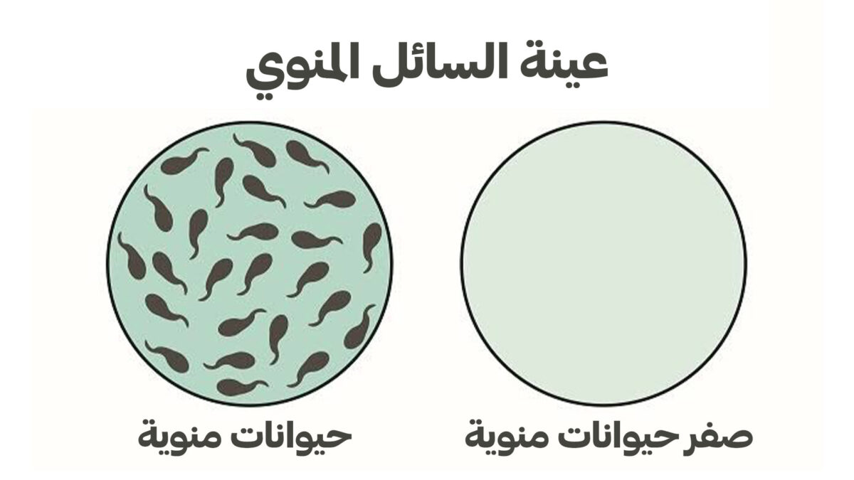 سبب ضعف الحيوانات المنويه