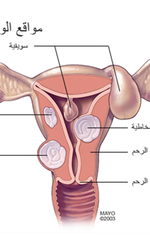 شكل الاورام الليفية في الرحم