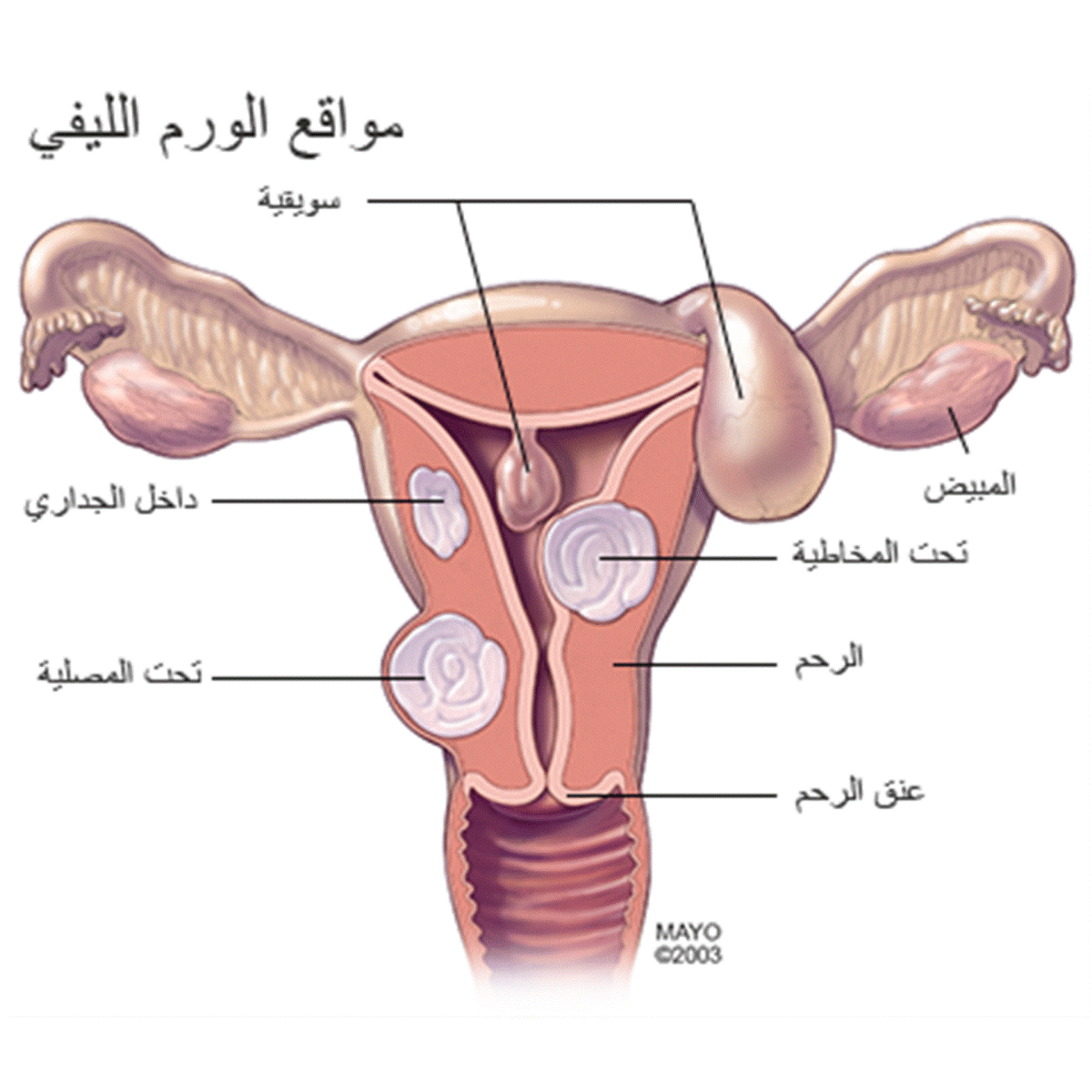 شكل الاورام الليفية في الرحم
