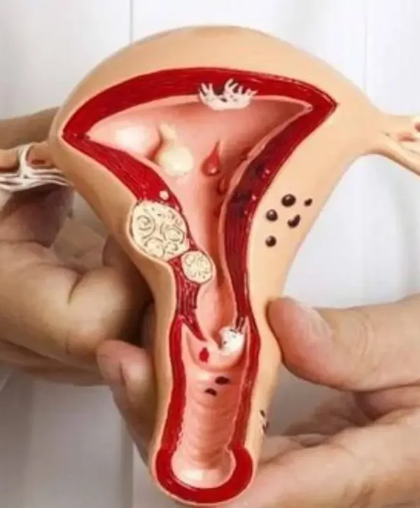 عدوى المهبل البكتيرية