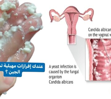 عدوى المهبل الفطرية