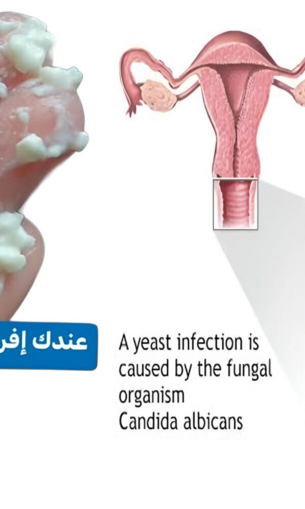 عدوى المهبل الفطرية