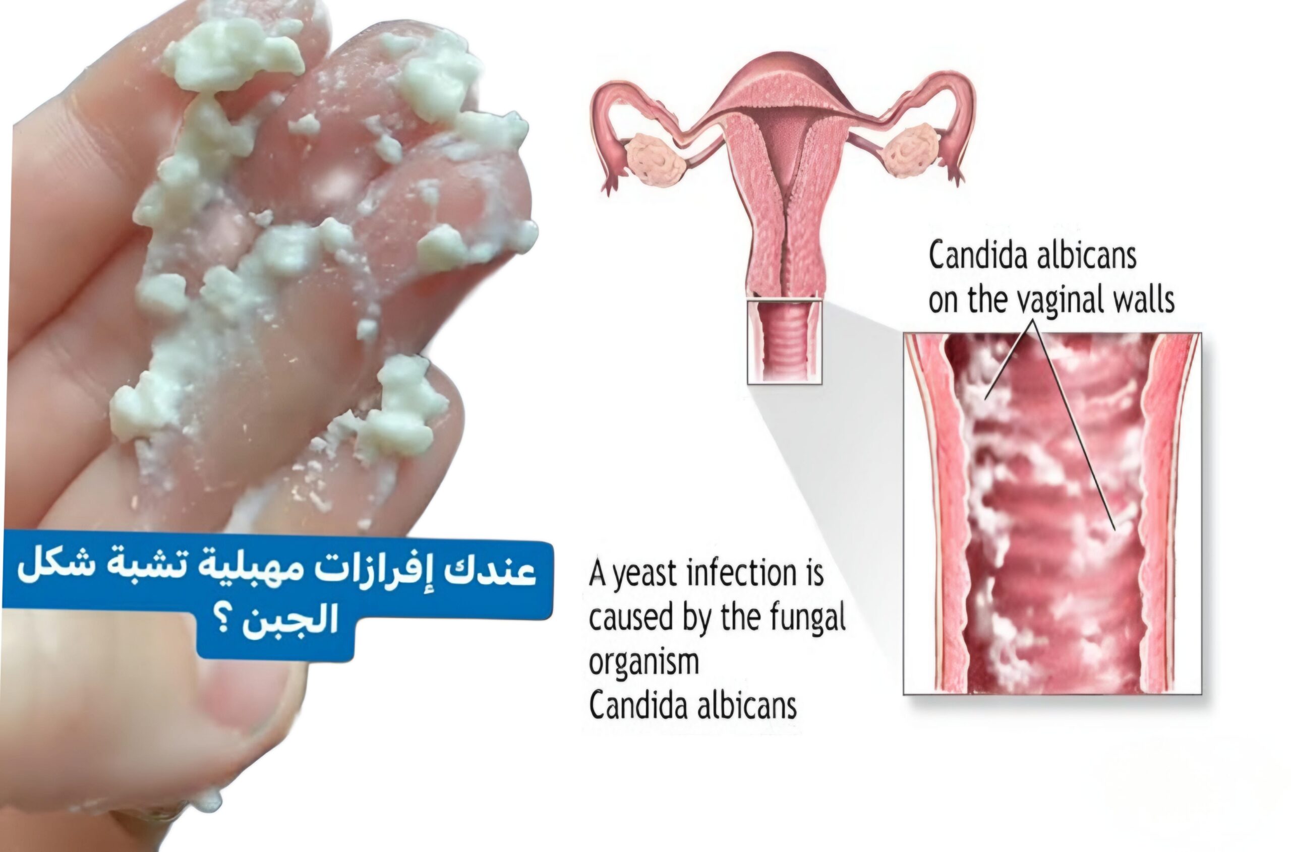عدوى المهبل الفطرية
