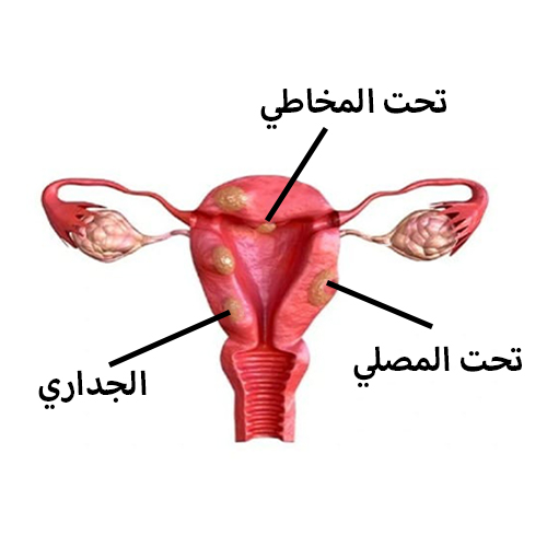 علاج الاورام الليفية في الرحم