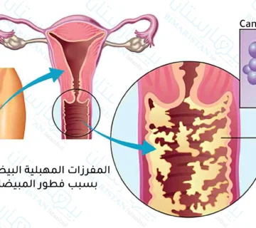 علاج التهاب الرحم والمهبل