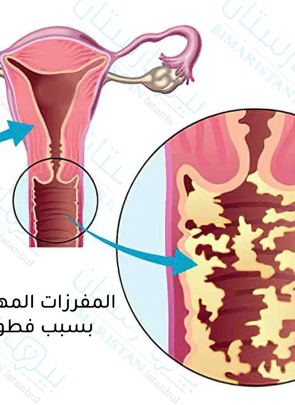 علاج التهاب الرحم والمهبل