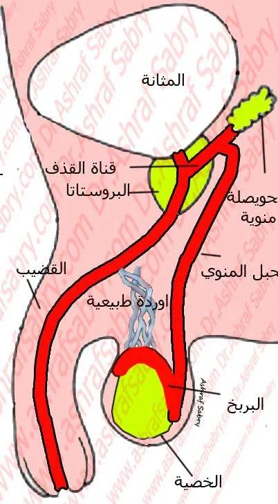 علاج تشوهات الحيوانات المنويه