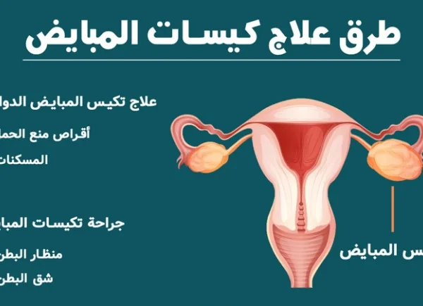 علاج تكيس المبايض للمتزوجة