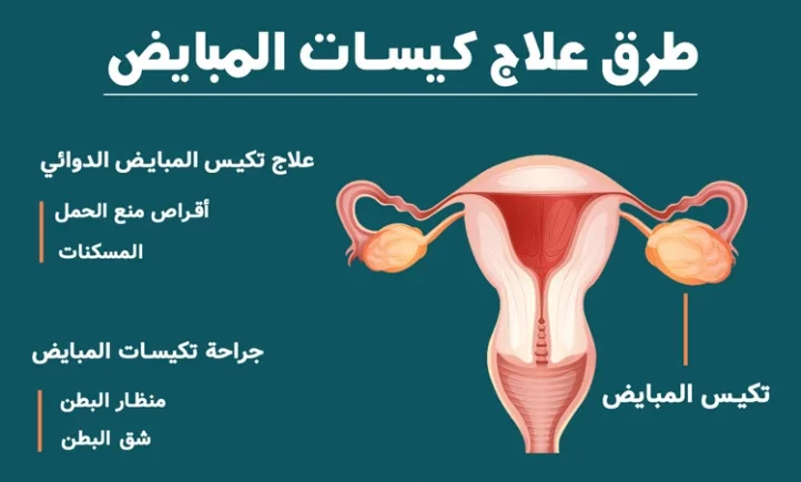 علاج تكيس المبايض للمتزوجة