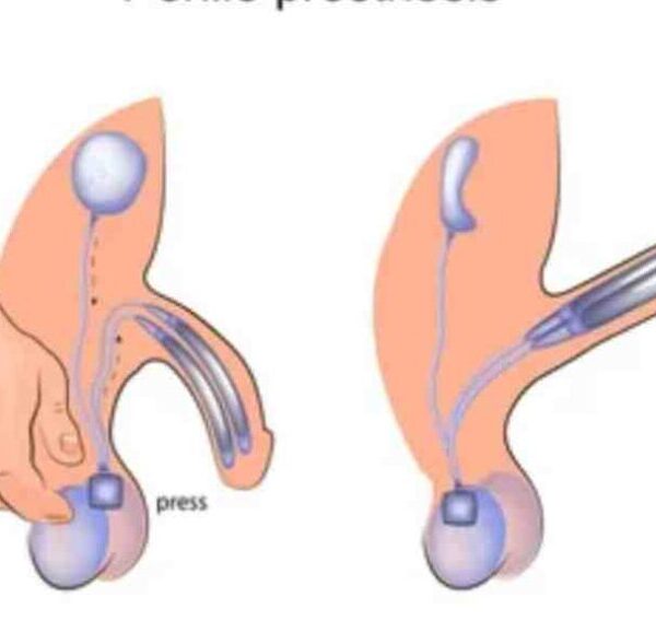 علاج ضعف الانتصاب أثناء الممارسة