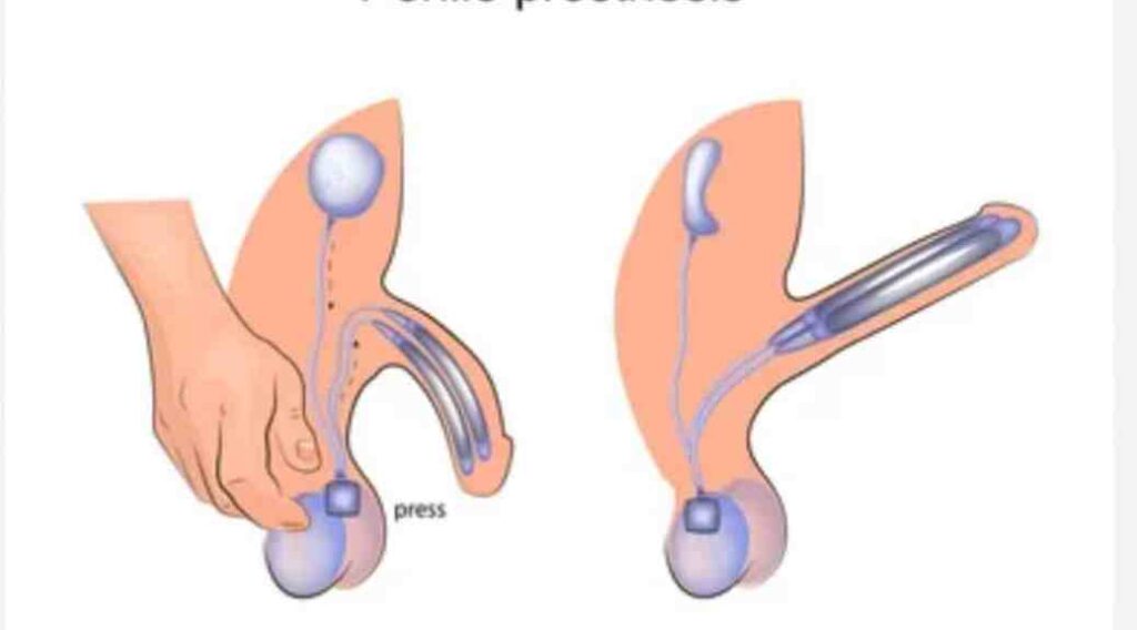 علاج ضعف الانتصاب أثناء الممارسة