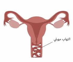 علاج عدوى المهبل الفطرية